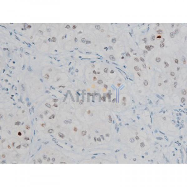 Phospho-Histone H2A.X (Ser139)[Ser140] Antibody - AF3187 at 1/200 staining Human kidney cancer tissue sections by IHC-P.